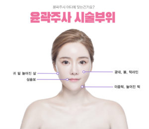 윤곽주사 시술부위 귀밑늘어진살 심술보 광대,볼, 턱라인 이중턱, 늘어진턱