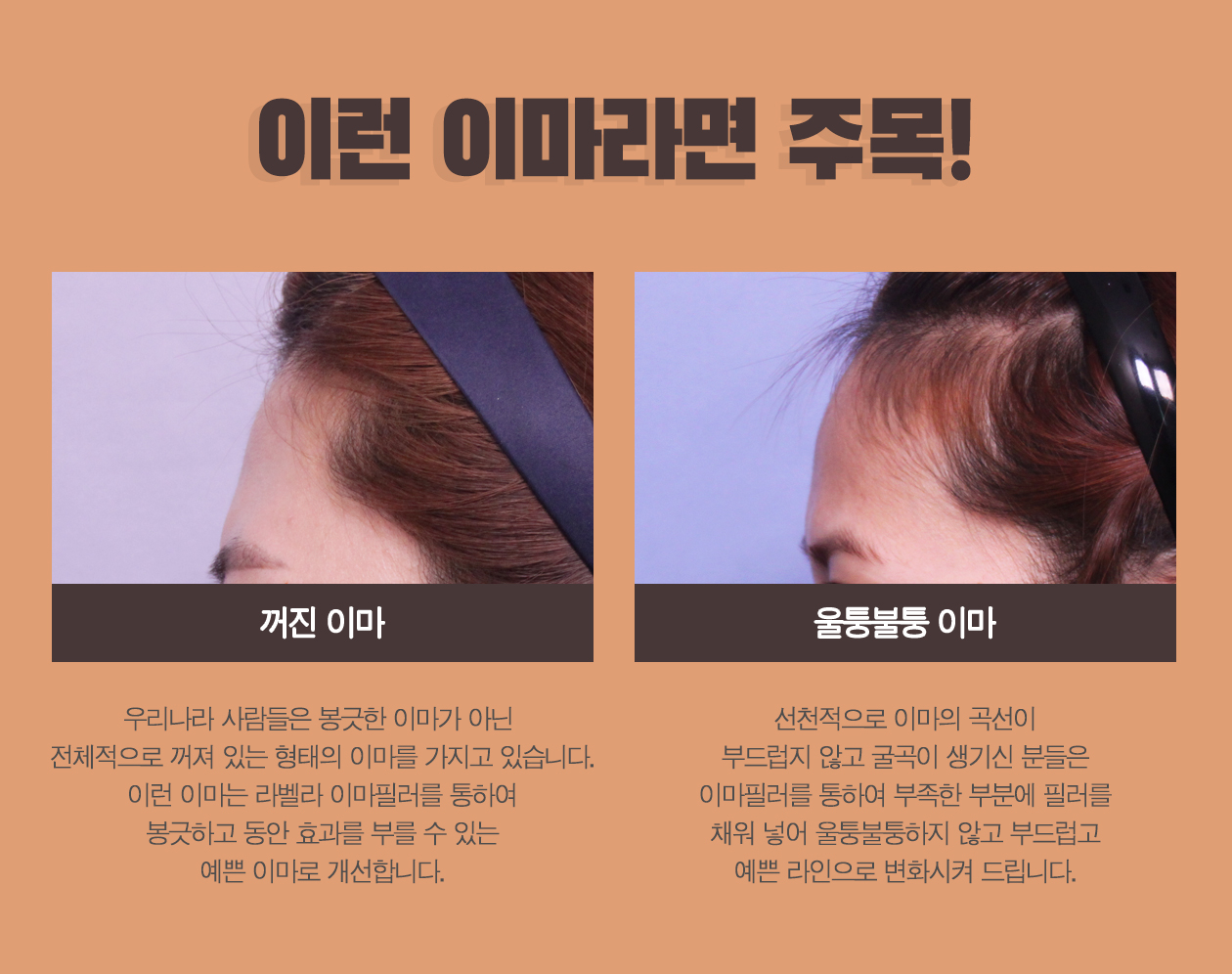 이마필러 - 강남 신논현역 성형외과 피부과 맑고고운 라벨라의원 이마필러 - 강남 신논현역 성형외과 피부과 맑고고운 라벨라의원
