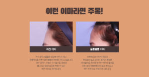 강남 신논현역 피부과 성형외과 라벨라 이런 이마라면 주목! 꺼진 이마 우리나라 사람들은 봉긋한 이마가 아닌 전체적으로 꺼져 있는 형태의 이마를 가지고 있습니다. 이런 이마는 라벨라 이마필러를 통하여 봉긋하고 동안 효과를 부를 수 있는 예쁜 이마로 개선합니다. 울퉁불퉁 이마 선천적으로 이마의 곡선이 부드럽지 않고 굴곡이 생기신 분들은 이마필러를 통하여 부족한 부분에 필러를 채워 넣어 울퉁불퉁하지 않고 부드럽고 예쁜 라인으로 변화시켜 드립니다.