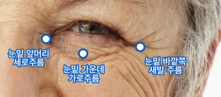 비수술눈밑잔주름치료 - 강남 신논현역 성형외과 피부과 맑고고운 라벨라의원 비수술눈밑잔주름치료 - 강남 신논현역 성형외과 피부과 맑고고운 라벨라의원