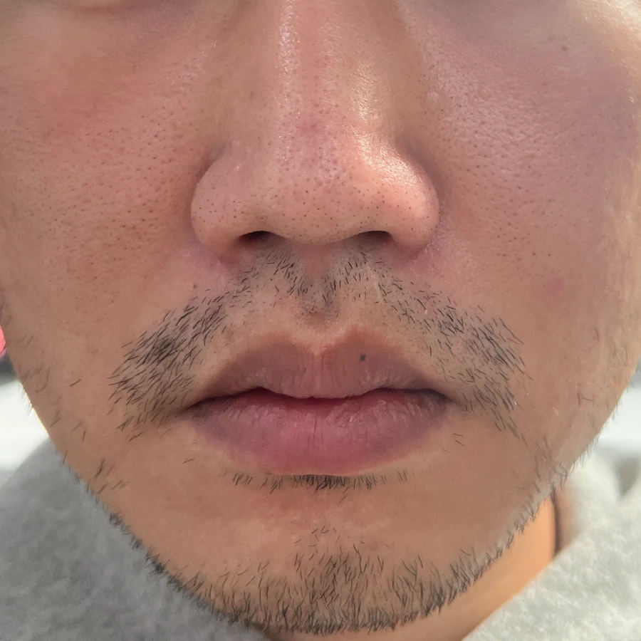 케이스1_시술 전