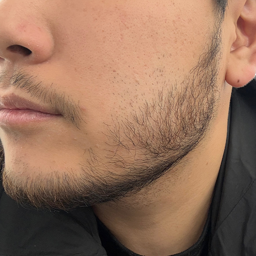 케이스2_시술 전