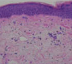 써마지FLX 작용 원리