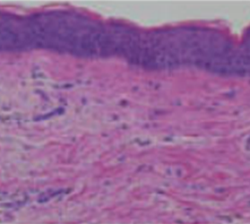 써마지FLX 콜라겐 재생