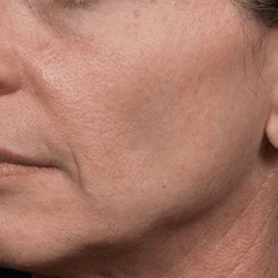 케이스1 시술 전