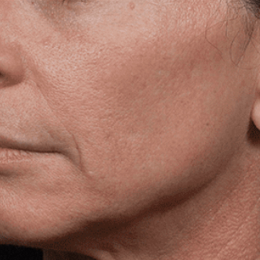 케이스1 시술 후