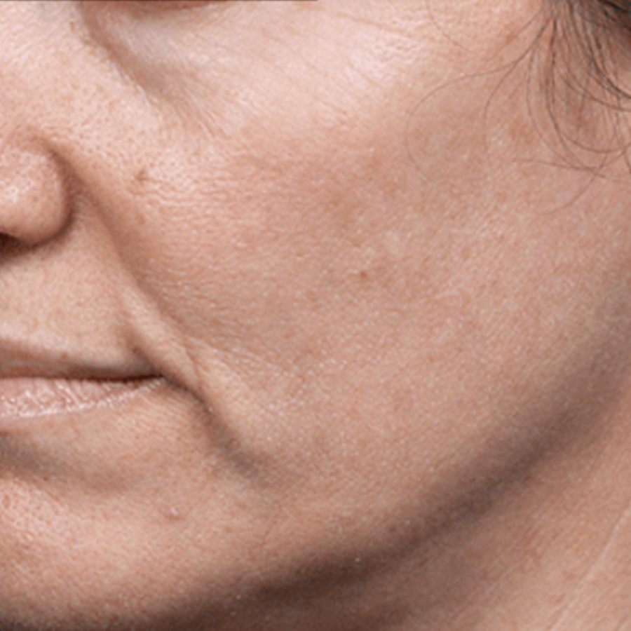 케이스2 시술 전