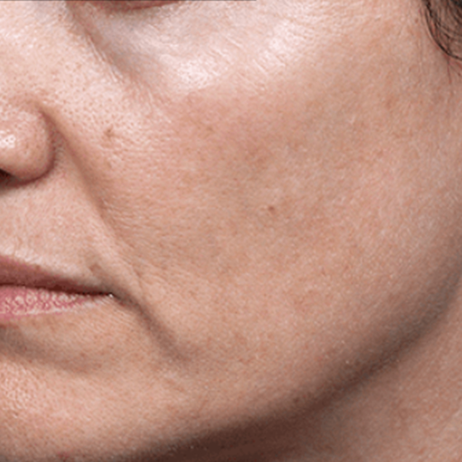 케이스2 시술 후