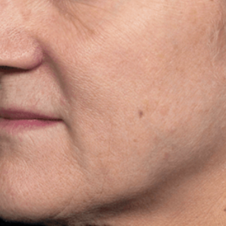 케이스3 시술 전