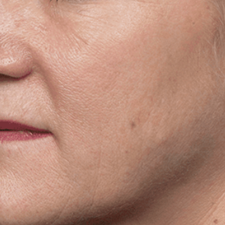 케이스3 시술 후