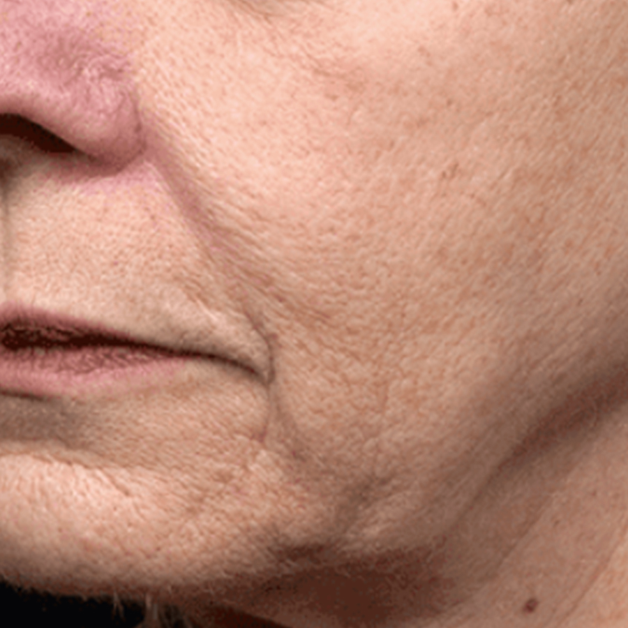 케이스4 시술 전