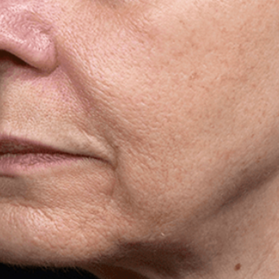 케이스4 시술 후