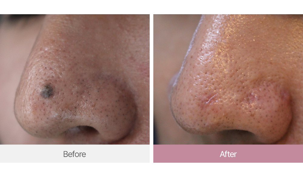 코점 제거 전후 전후 통합 이미지