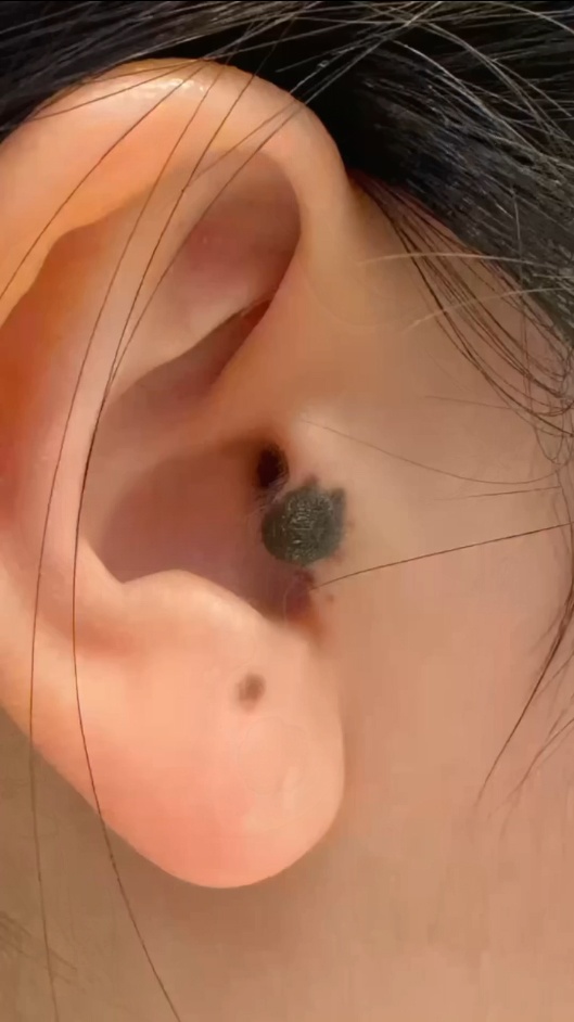 귀에 점 제거를 위해 내원한 환자의 귀 안쪽 큰 점, 내원 당시 측면 모습
