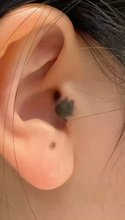 귀에 점 분할 제거 전 귀 안쪽의 크고 튀어나온 점, 내원 당시
