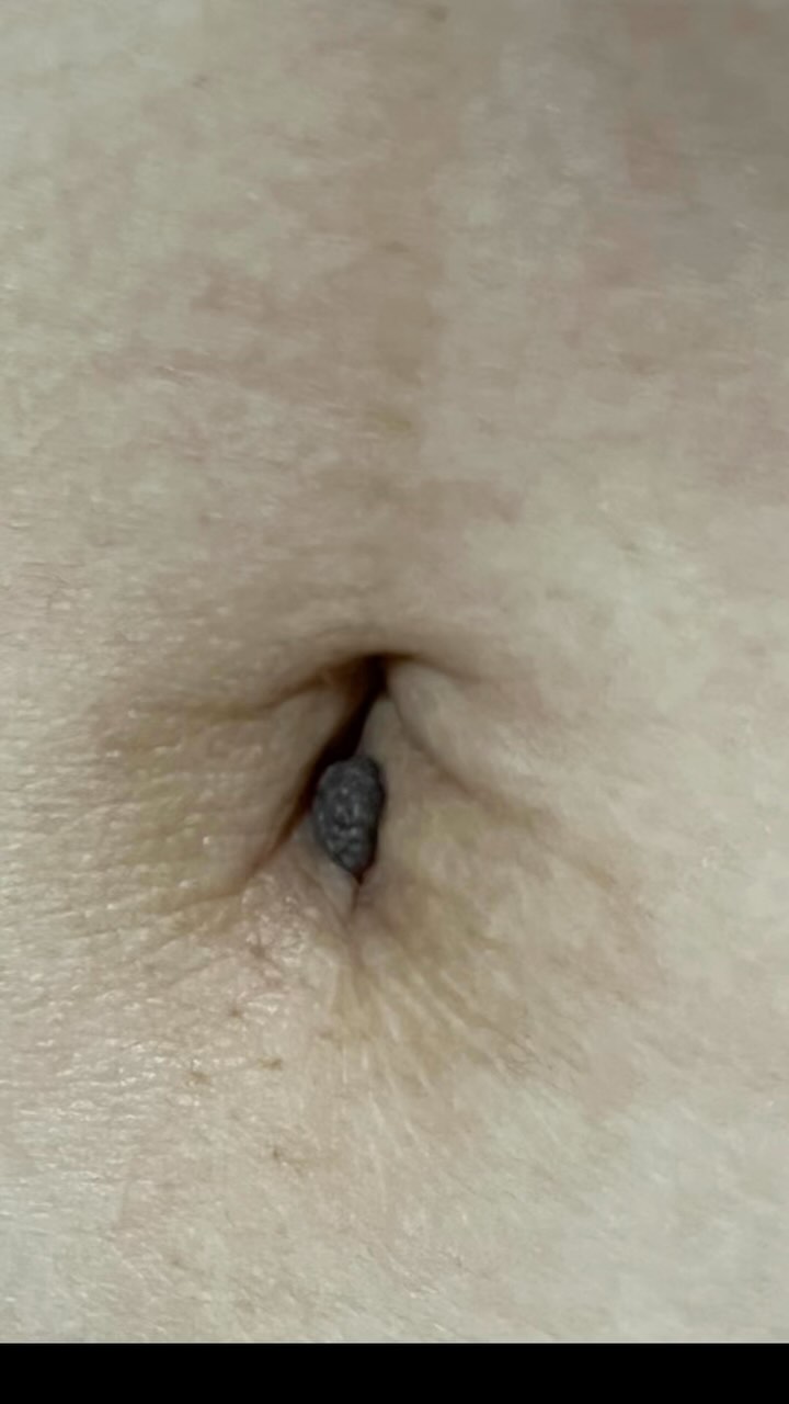 배꼽점 제거와 일자 배꼽
