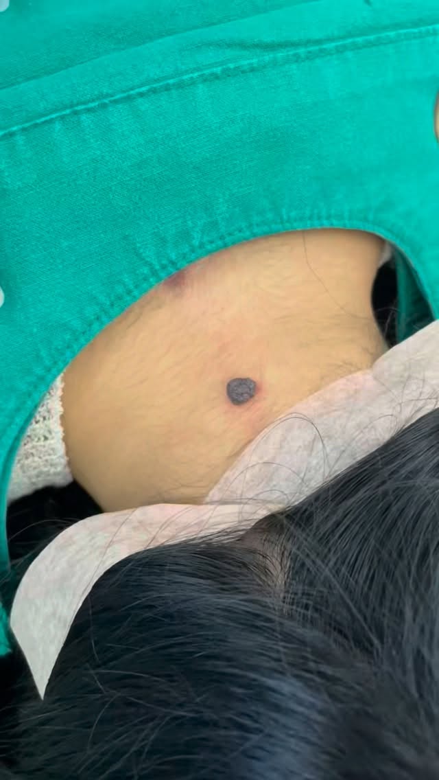 목점 제거, 돌려깎기