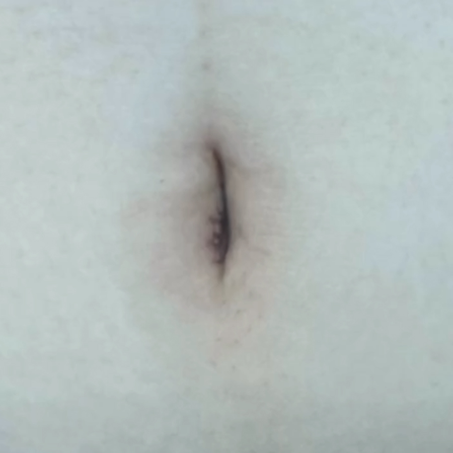 배꼽점 절제·봉합 후 실밥을 제거한 모습