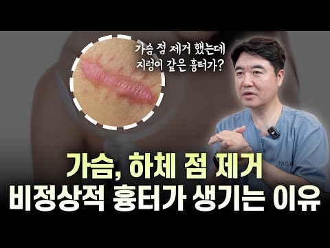 가슴, 하체 점 제거? 흉터에 대한 주의사항이 있습니다