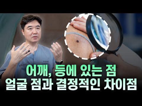 몸에 난 점? 이 사실을 모르고 빼면 99% 후회합니다 (등, 어깨, 쇄골 점)