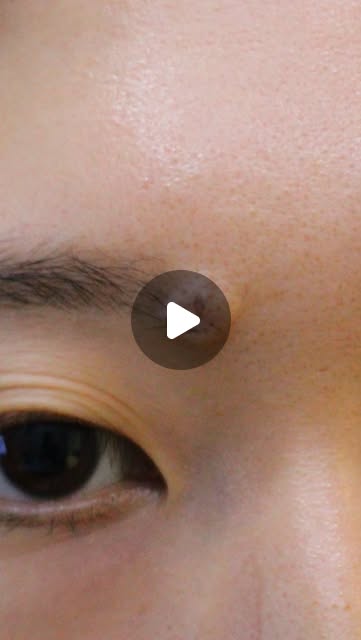 눈썹점 7개월 레이저 분할 제거