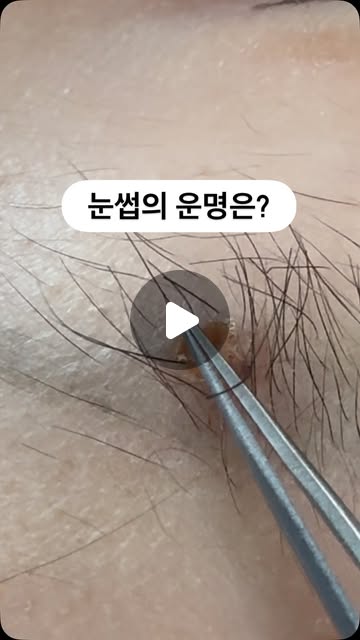 눈썹점 제거의 핵심은 눈썹 보존