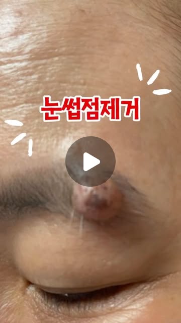 눈썹점 제거, 고민하지 마세요