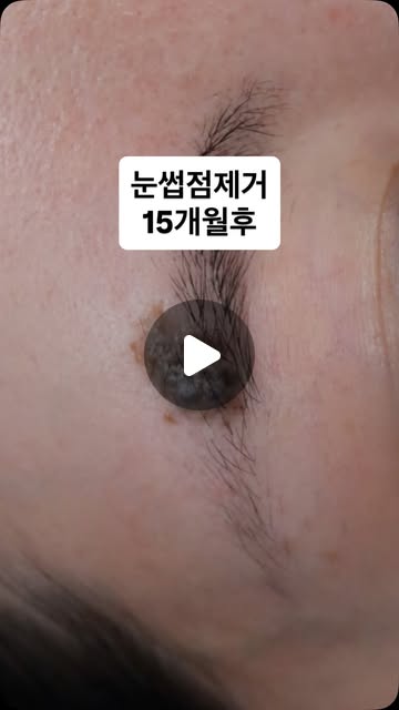 눈썹점 제거 15개월 후