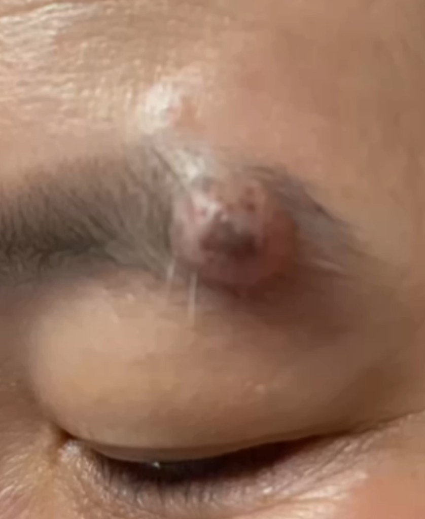 눈썹 모근과 겹친 큰 눈썹점