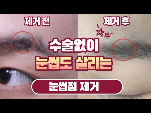 눈썹점 제거 방법을 설명하는 조현진 대표원장 영상 썸네일