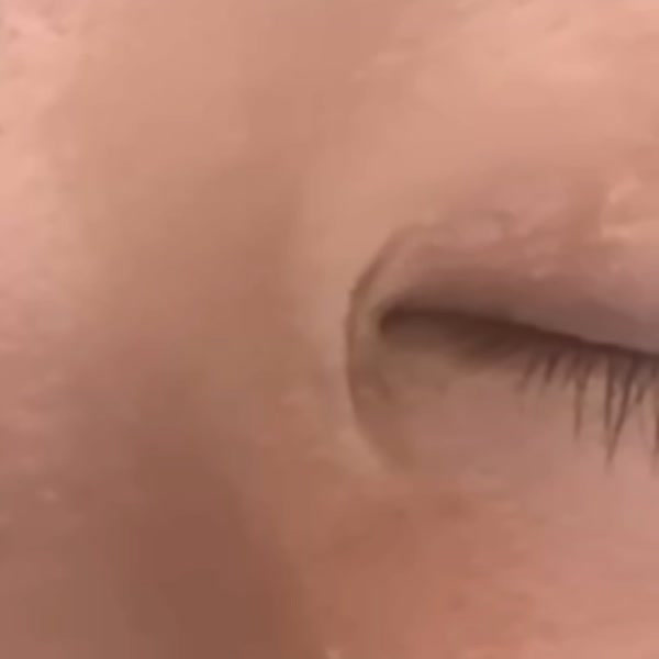 갈고리 모양으로 벌어진 앞트임 흉터 치료 전