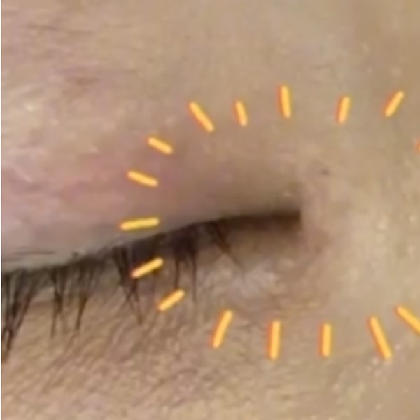 패인 앞트임 흉터 비수술 치료 후