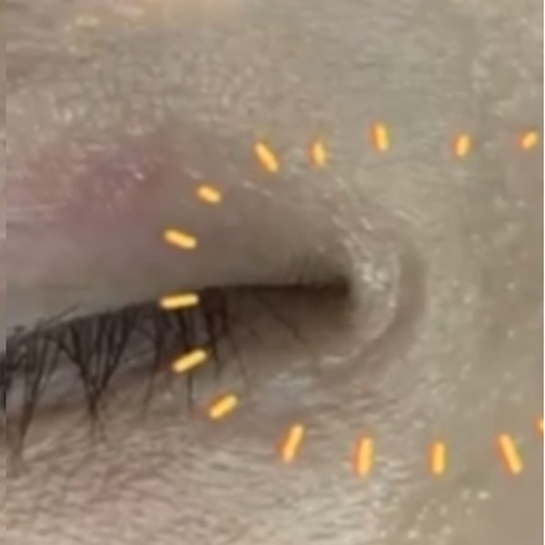 깊게 패인 앞트임 흉터 치료 전