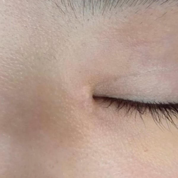 앞트임 복원 수술 흉터 비수술 치료 후