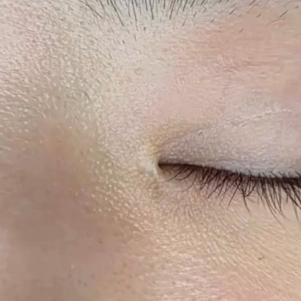 앞트임 복원 수술 후 남은 하얀 흉터 치료 전