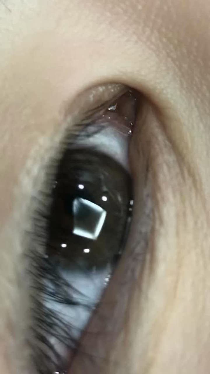 앞트임 흉터 치료 경과