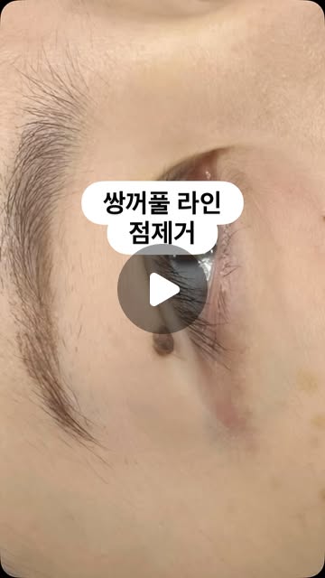 쌍꺼풀 라인 점 제거