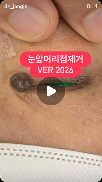 눈앞머리점 제거