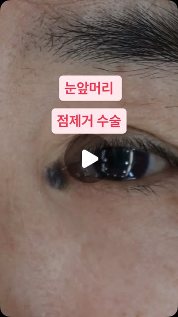 눈앞머리점 제거
