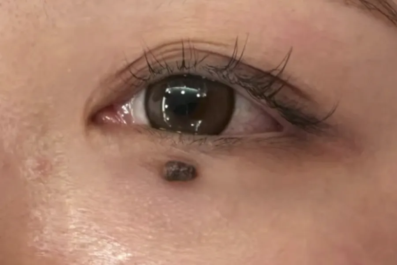 애교살과 겹친 눈밑점