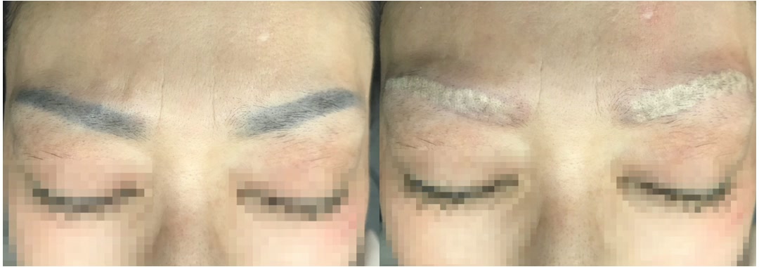 5년 넘은 반영구 눈썹 1회 전·직후