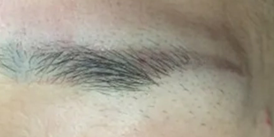 푸르게 변색된 오래된 눈썹 문신 제거 전