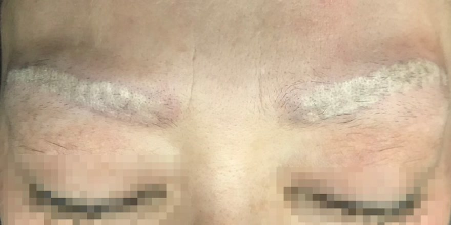 양쪽 눈썹 문신제거 1회 시술 직후