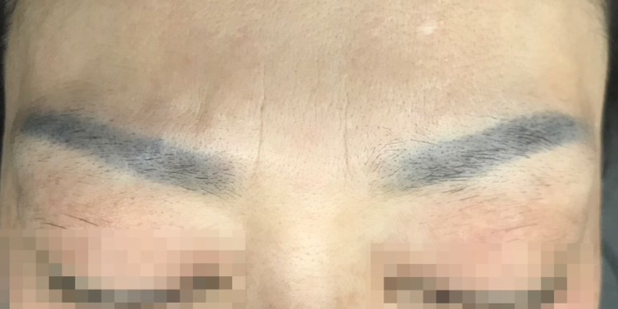5년 넘게 남아 푸르게 변한 양쪽 눈썹 문신 제거 전