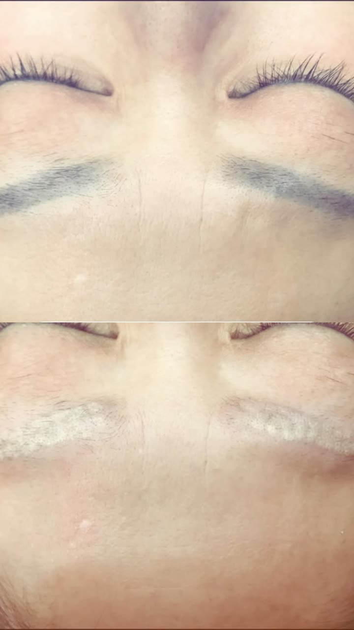 눈썹 문신제거 시술 영상