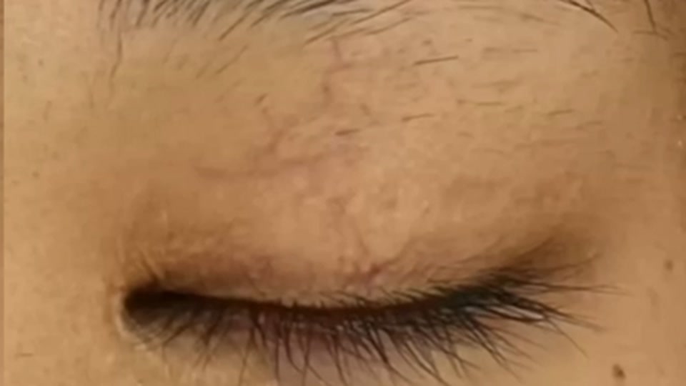 패인 쌍꺼풀 절개 흉터 3회 치료 후