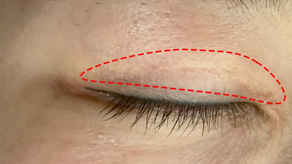 오래되어 하얗고 울퉁불퉁한 쌍꺼풀 흉터 치료 전
