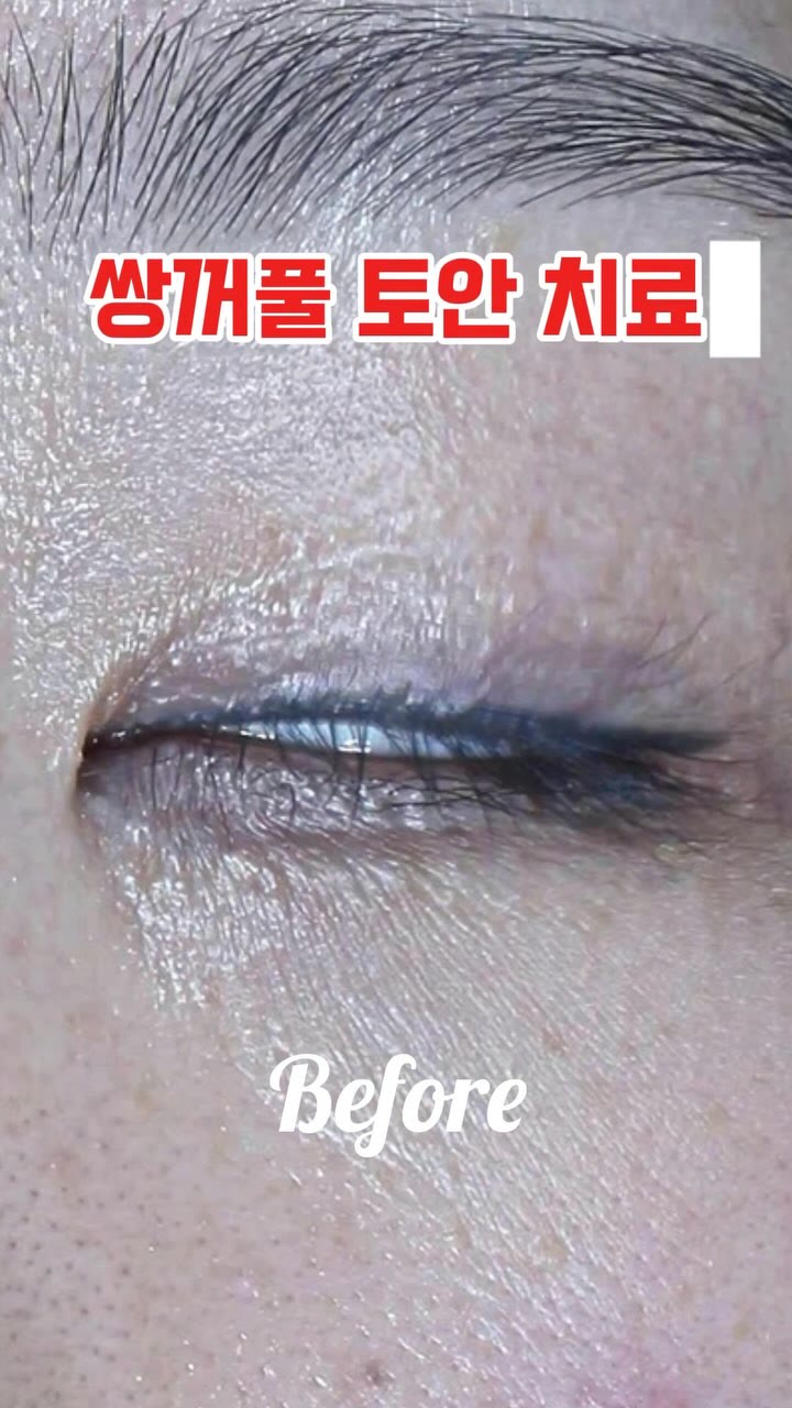 쌍꺼풀 수술 후 토안 치료