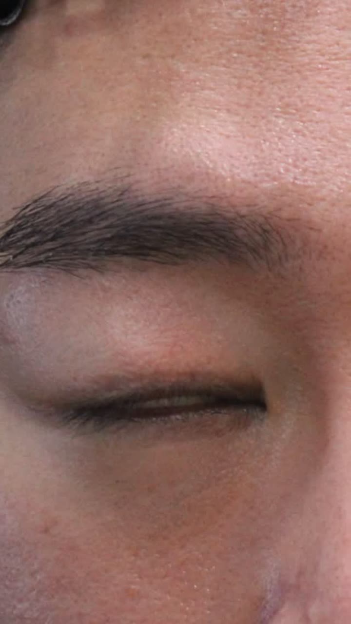 쌍꺼풀 수술 흉터와 토안 치료