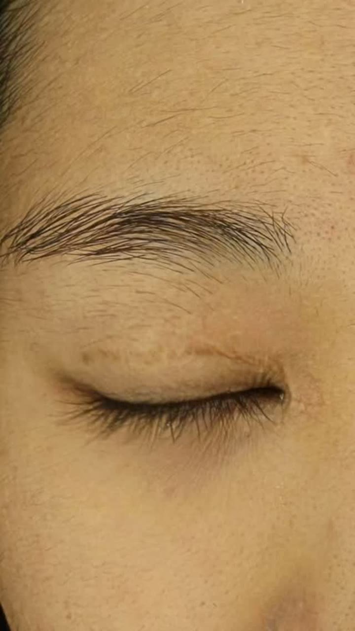 쌍꺼풀 수술 흉터 치료